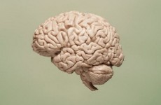 مسح للدماغ يوضح كيف يمكن البقاء على قيد الحياة بنصف مخ!