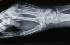 حالة طبية نادرة تسبب "اختفاء" عظام أصابع امرأة