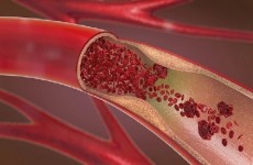دعامات الأوعية الدموية أعظم إنجاز في مجال الطب