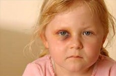 الصحة تحذر من خطر يهدد عيون الاطفال خلال ايام العيد