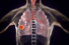 طبيب روسي يحدد الأكثر عرضة للإصابة بسرطان الرئة