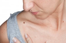 أطباء بريطانيون يحذرون ممّا يسبب طفرة في سرطان الجلد!