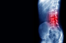 صور صادمة للأشعة السينية تظهر كيفية تسبب "غاز الضحك" في شلل رجل