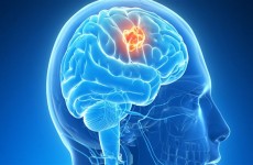 أخصائي أورام يحدد أعراض سرطان الدماغ في المراحل الأولى