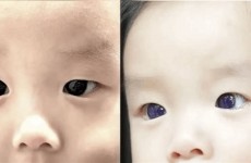 بسبب دواء معين.. تحول عيون طفل تايلاندي من اللون البني الداكن إلى الأزرق