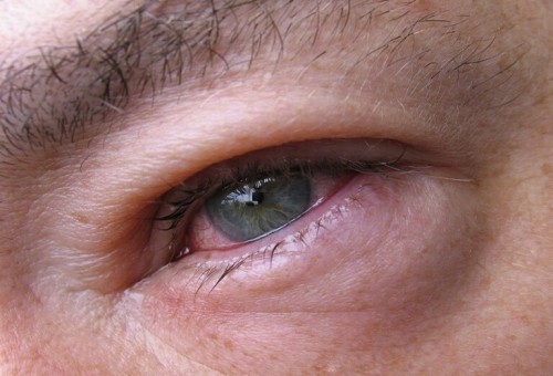 طبيب عيون يوضح ما الذي يحفز التهاب الملتحمة